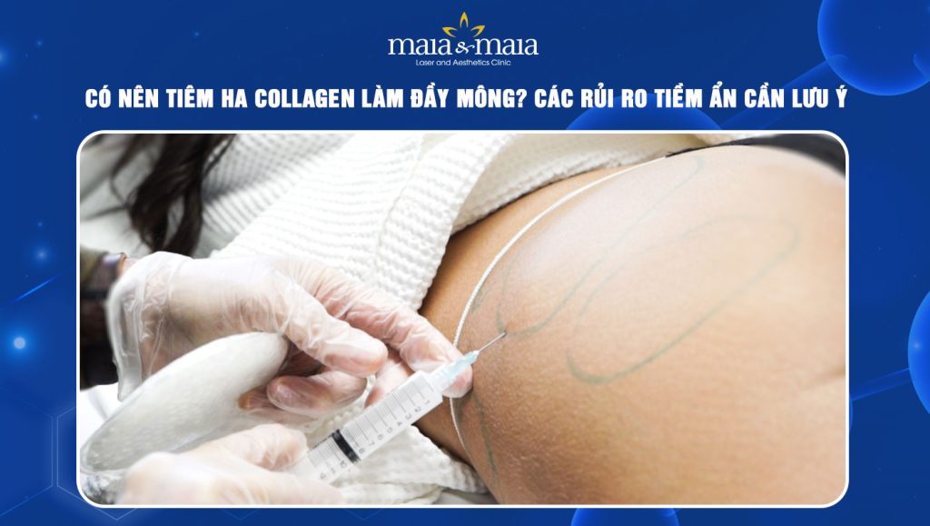 Tiêm HA collagen làm đầy mông
