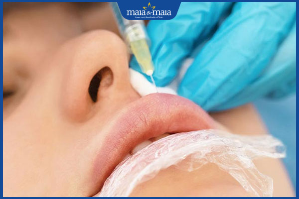 Dấu hiệu cảnh báo tiêm filler môi bị hỏng và cách xử lý hiệu quả 4 tiêm tan filler ở môi