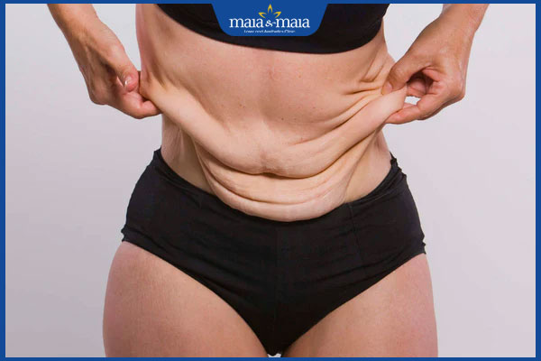 tình trạng da chảy xệ sau giảm cân