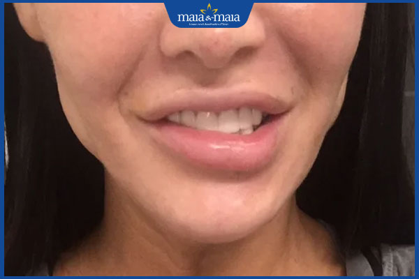 Tiêm filler cằm bị lệch có nguy hiểm không? Nguyên nhân và hướng dẫn xử lý hiệu quả 2 tình trạng lệch cằm sau tiêm filler