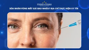 Xóa nhăn vùng mắt giá bao nhiêu? Địa chỉ thực hiện uy tín 72 xóa nhăn vùng mặt giá bao nhiêu