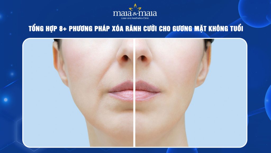 xóa rãnh cười