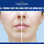 xóa rãnh cười