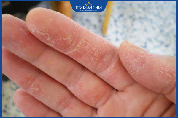 Da tay nhăn nheo do đâu? Địa chỉ trẻ hóa da tay uy tín 2 da tay khô bong tróc