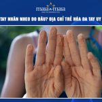 da tay nhăn nheo