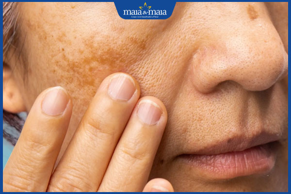 Bật mí 5+ bí quyết chống lão hóa da tuổi 30 hiệu quả, chi tiết nhất! 2 da thâm sạm