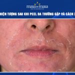 hiện tượng sau khi peel da