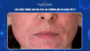 Các hiện tượng sau khi peel da thường gặp và cách xử lý 88 hiện tượng sau khi peel da