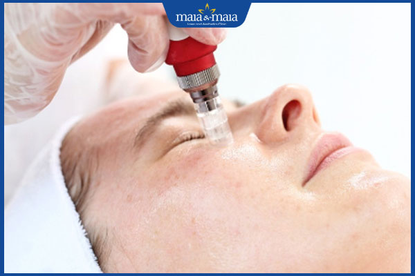 Gợi ý các cách xóa nếp nhăn vùng mắt an toàn và hiệu quả 6 lăn kim vi điểm