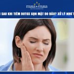 mỏi hàm sau khi tiêm botox gọn mặt