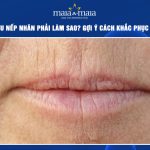 môi nhiều nếp nhăn