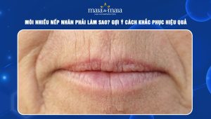 Môi nhiều nếp nhăn phải làm sao? Gợi ý cách khắc phục hiệu quả 44 môi nhiều nếp nhăn