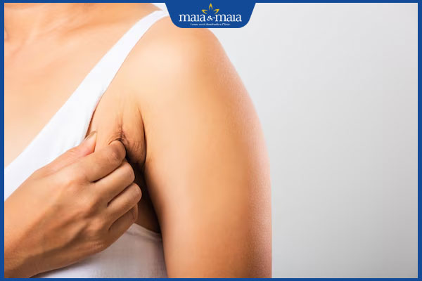 nách có nếp nhăn