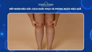 Nếp nhăn đầu gối: Cách khắc phục và phòng ngừa hiệu quả 91 nếp nhăn đầu gối