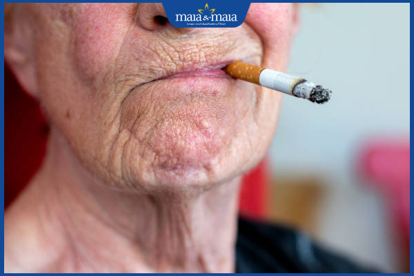 Điểm danh 10+ cách xóa nếp nhăn giúp làn da trẻ mãi 2 nếp nhăn do hút thuốc