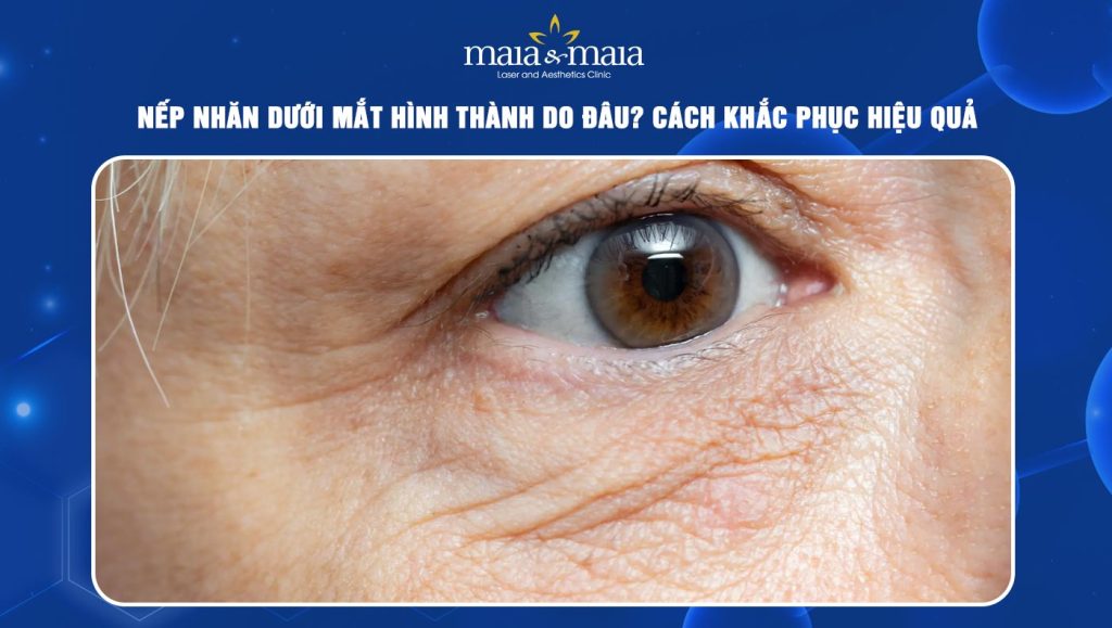 Nếp nhăn dưới mắt hình thành do đâu? Cách khắc phục hiệu quả 1 Nếp nhăn dưới mắt