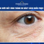 Nếp nhăn dưới mắt