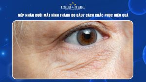 Nếp nhăn dưới mắt hình thành do đâu? Cách khắc phục hiệu quả 87 Nếp nhăn dưới mắt