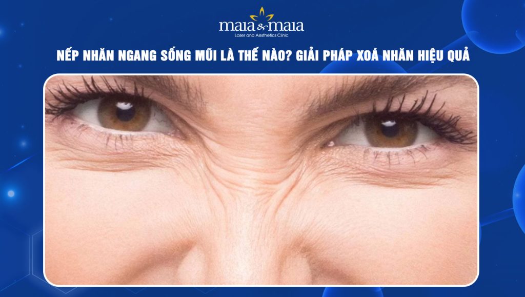 Nếp nhăn ngang sống mũi