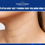 Nếp nhăn ở cổ