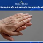 nếp nhăn ở ngón tay