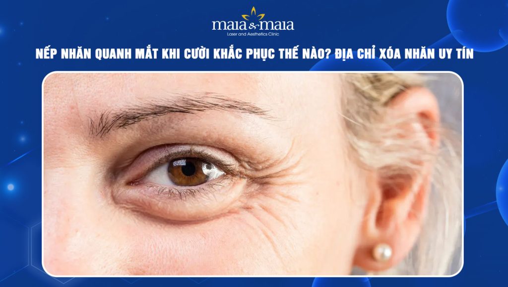 Nếp nhăn quanh mắt khi cười
