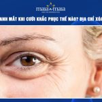 Nếp nhăn quanh mắt khi cười