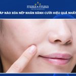 nếp nhăn rãnh cười