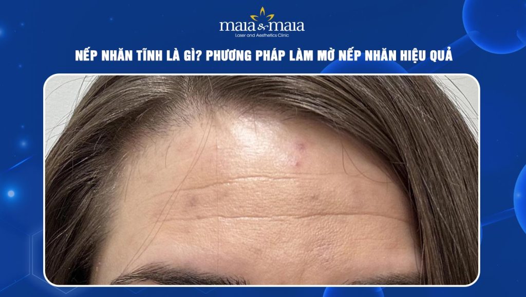 nếp nhăn tĩnh