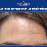 nếp nhăn tĩnh