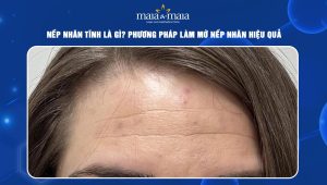 Nếp nhăn tĩnh là gì? Phương pháp làm mờ nếp nhăn hiệu quả 51 nếp nhăn tĩnh