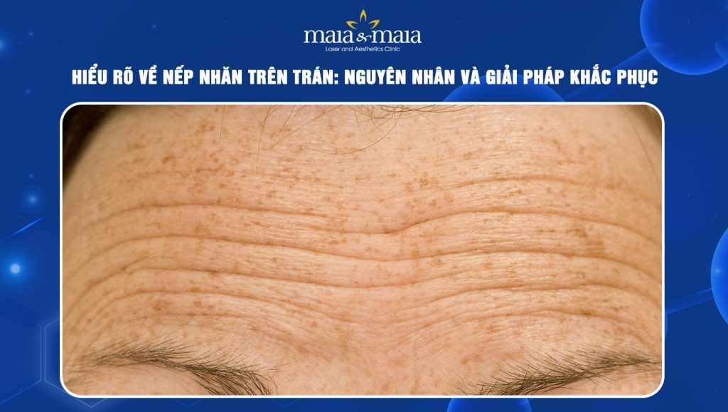 Nếp nhăn trên trán