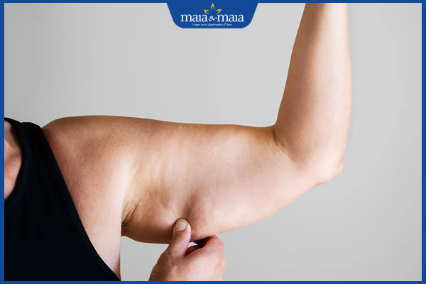 Tiêm botox bắp tay có lợi ích gì? Quy trình và chi phí thực hiện 3 người có bắp tay to