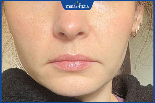 Tiêm botox khóe miệng có nên không? Lưu ý khi thực hiện 3 người có khóe miệng buồn