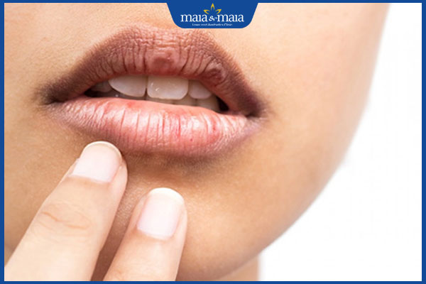 Thế nào là trẻ hóa môi bằng plasma? Cần lưu ý gì để duy trì hiệu quả lâu dài? 3 người môi khô và thâm