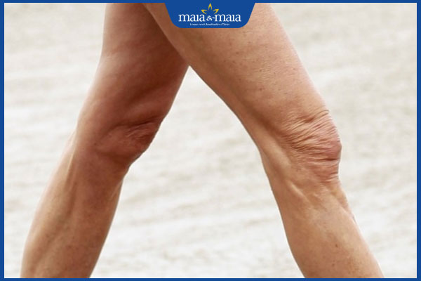 nhiều nếp nhăn ở đầu gối