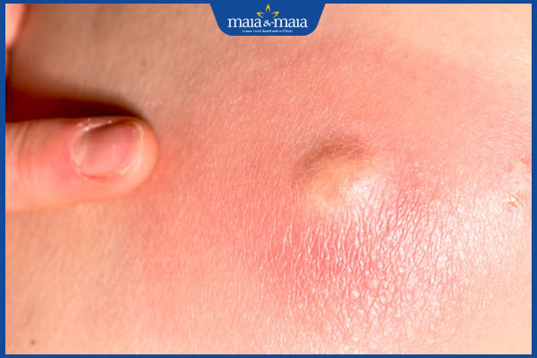 nổi cục sau tiêm