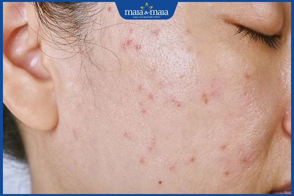 nổi mụn sau peel da