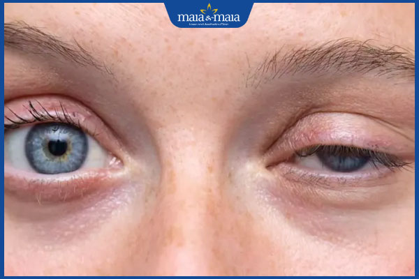 Tiêm botox xóa nhăn đuôi mắt giá bao nhiêu? Chi phí đắt hay rẻ? 3 rủi ro khi tiêm botox giá rẻ