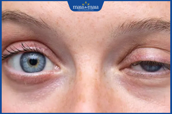 Tiêm botox sụp mí mắt: Nguyên nhân, cách xử lý và phòng tránh hiệu quả 2 sụp mí mắt sau tiêm botox