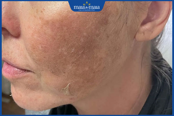 tăng sắc tố sau peel