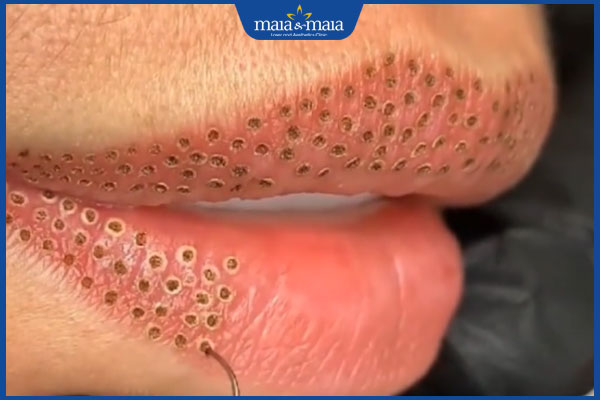 Thế nào là trẻ hóa môi bằng plasma? Cần lưu ý gì để duy trì hiệu quả lâu dài? 4 thực hiện bắn plasma