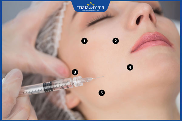 thực hiện tiêm bap 5 điểm