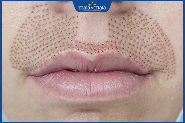 Thế nào là trẻ hóa môi bằng plasma? Cần lưu ý gì để duy trì hiệu quả lâu dài? 2 thực hiện trẻ hóa môi bằng plasma