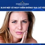 tiêm botox bị đơ mặ