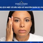 tiêm botox bị lệch mặt