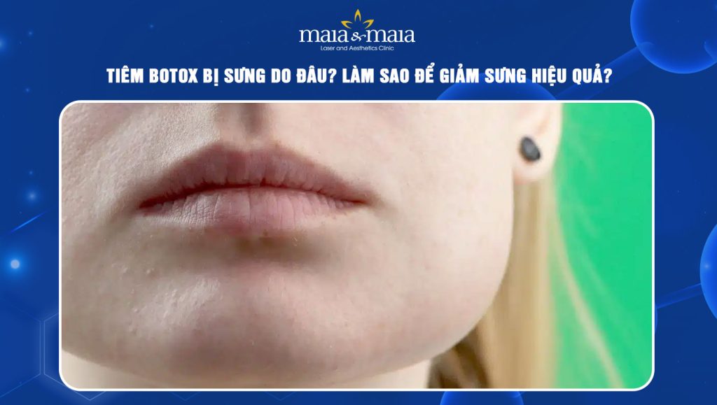 Tiêm botox bị sưng