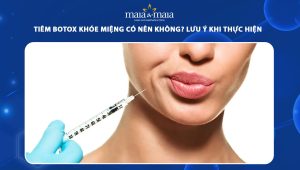 Tiêm botox khóe miệng có nên không? Lưu ý khi thực hiện 76 tiêm botox khóe miệng