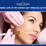 tiêm botox rãnh cười