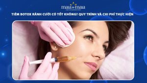 Tiêm botox rãnh cười có tốt không? Quy trình và chi phí thực hiện 52 tiêm botox rãnh cười